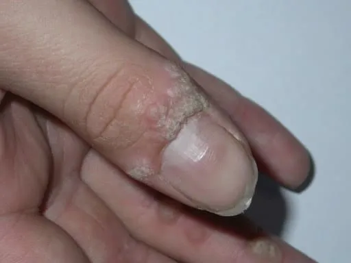 mụn cóc quanh móng