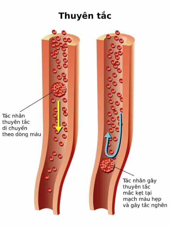 thuyên tắc mạch máu