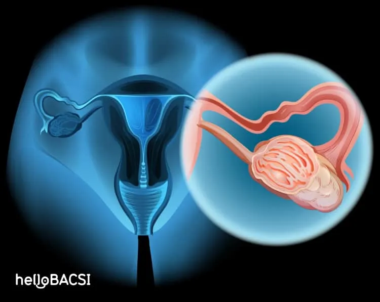 Ánh nắng mặt trời giúp ngăn ngừa ung thư buồng trứng