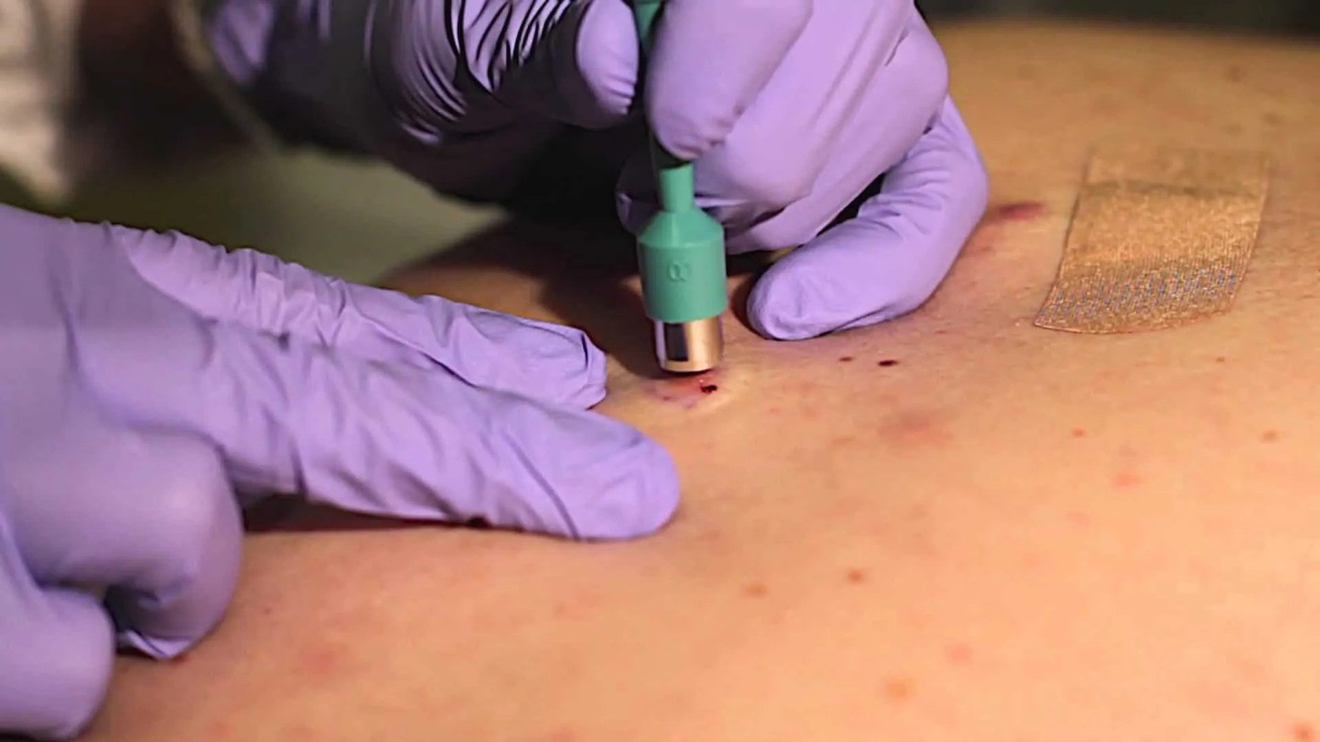 Nguyên nhân khiến nốt ruồi bị ngứa