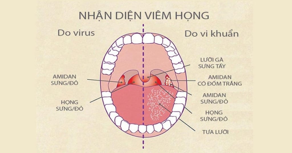 triệu chứng viêm họng do virus và vi khuẩn