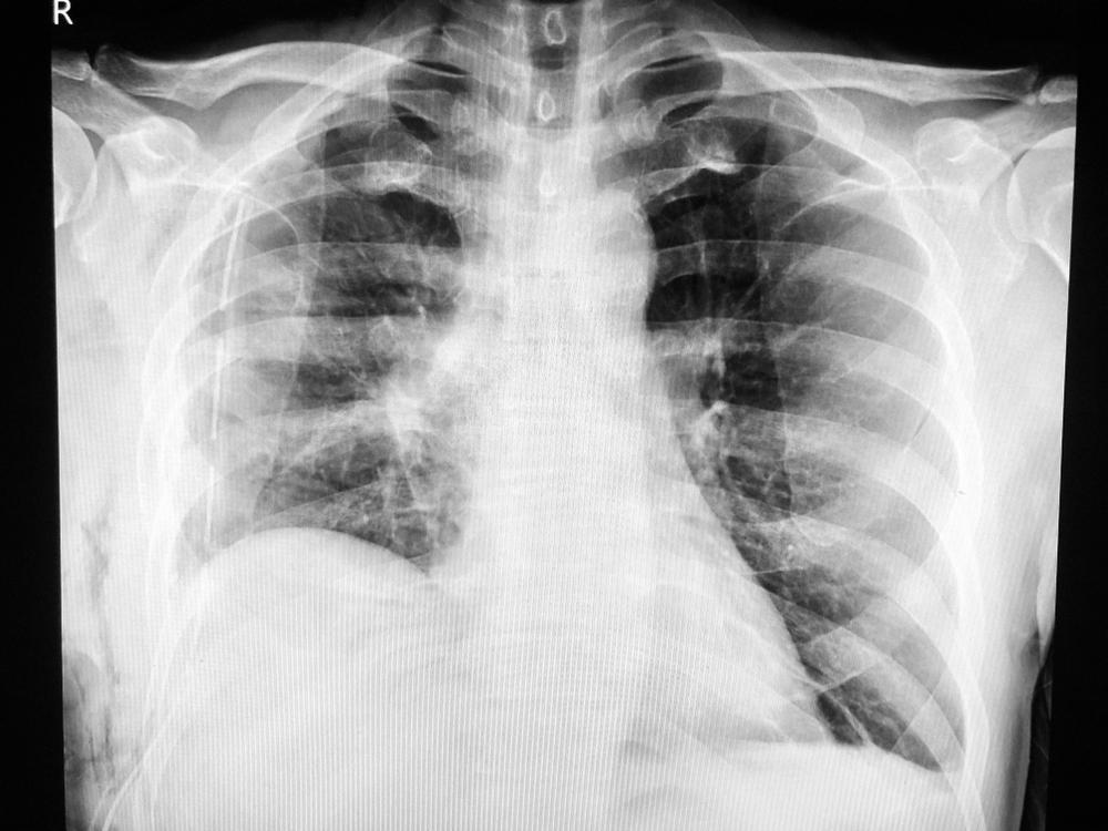 Chụp X quang trước dẫn lưu màng phổi