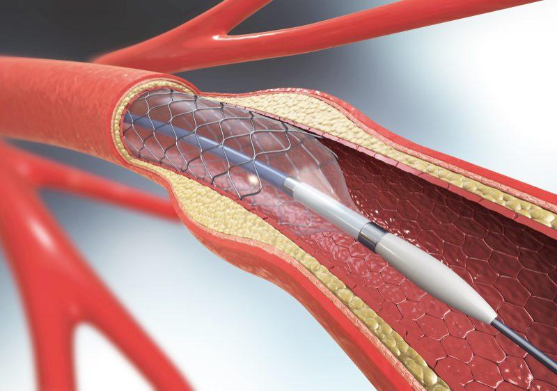 đặt stent động mạch vành