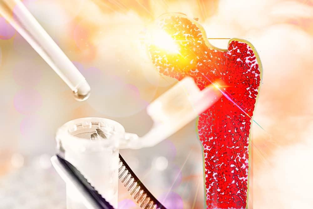 nguyên nhân bệnh bạch cầu cấp dòng lympho