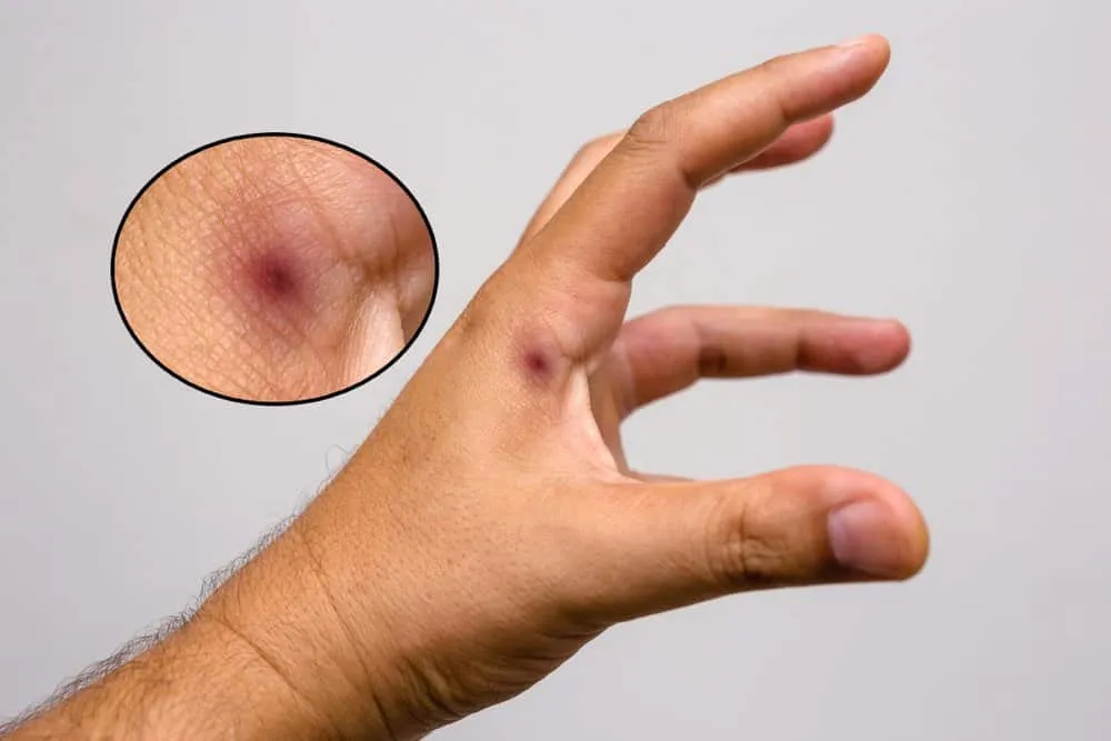 bị ong đốt nên làm gì