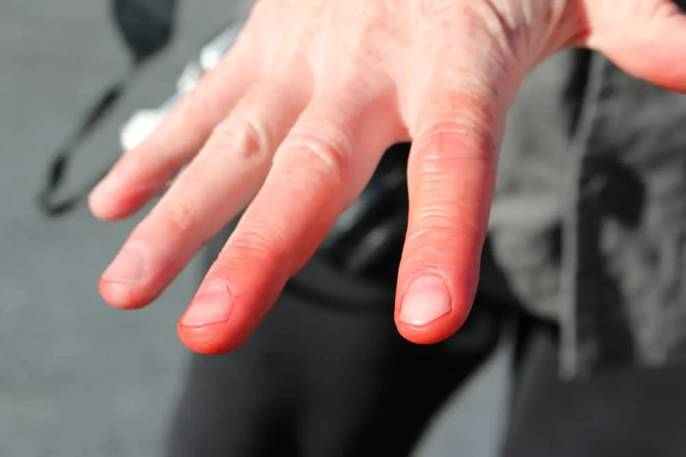 Những dấu hiệu bị bỏng lạnh