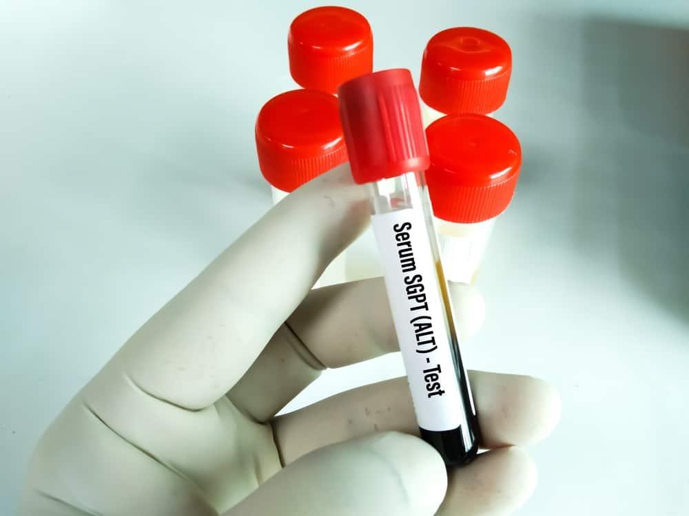 khi nào cần Xét nghiệm ALT/GPT