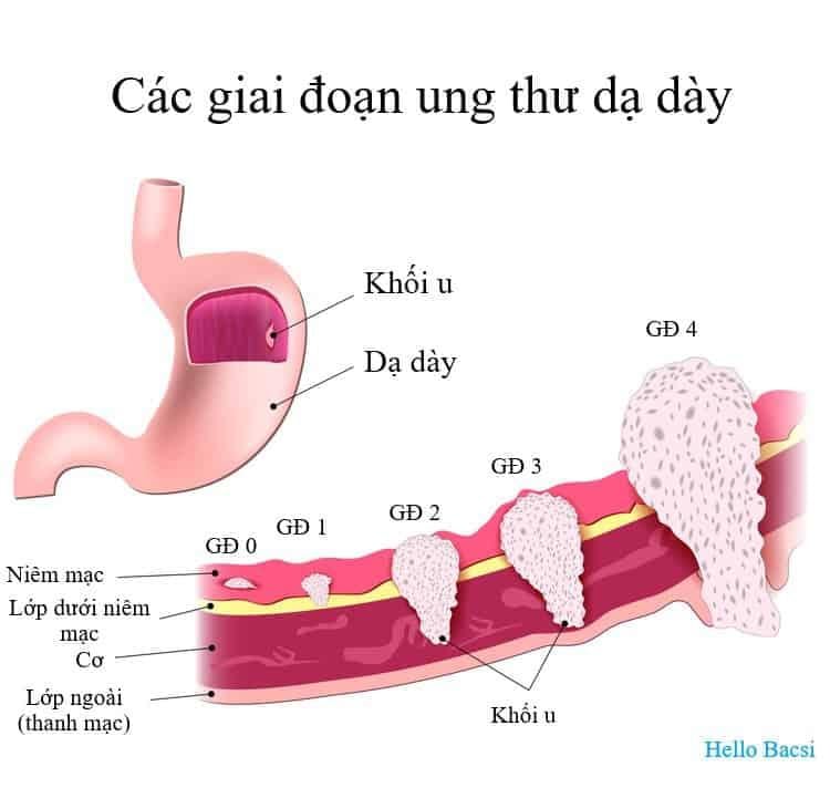 Các giai đoạn ung thư dạ dày