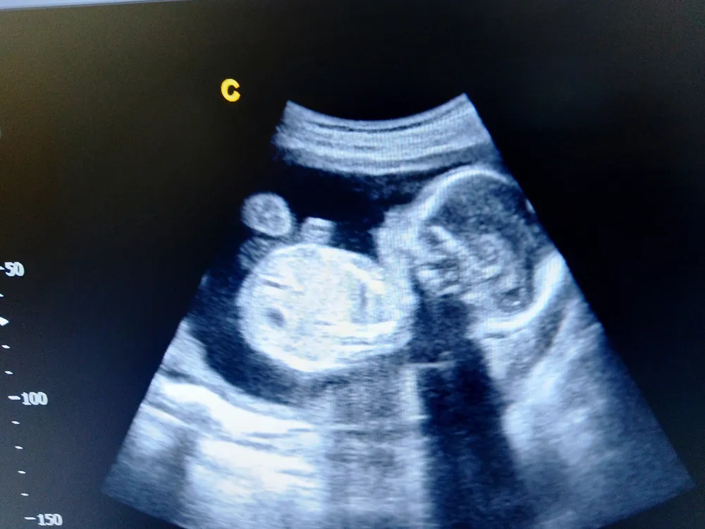 Hình ảnh siêu âm thai 20 tuần trong bụng mẹ