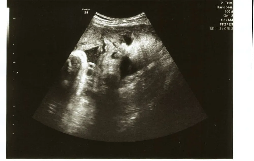 hình ảnh siêu âm thai 33 tuần