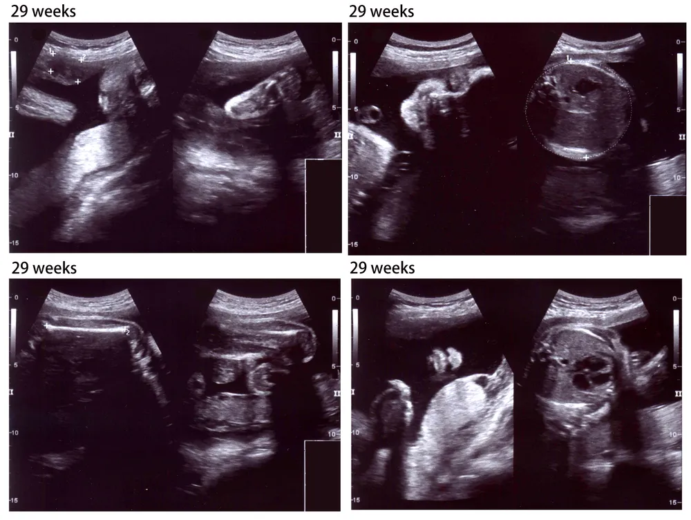 hình siêu âm tuần thai 29