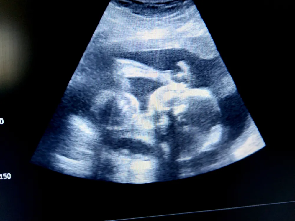 Siêu âm thai 26 tuần trong bụng mẹ