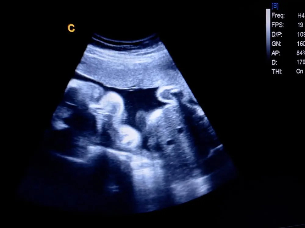 Hình ảnh thai nhi 28 tuần