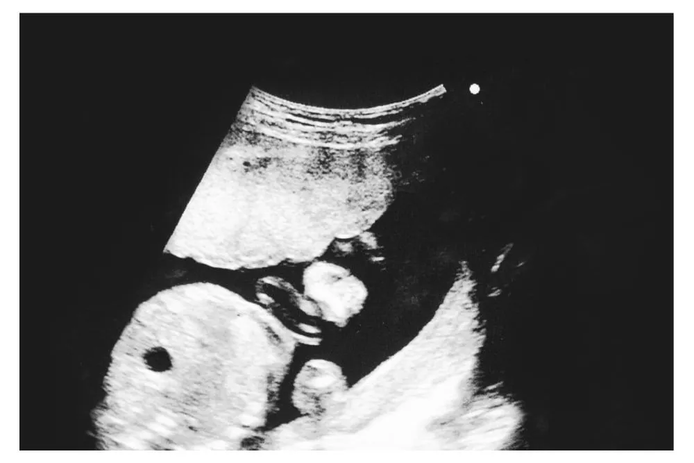 Hình ảnh siêu âm thai 21 tuần