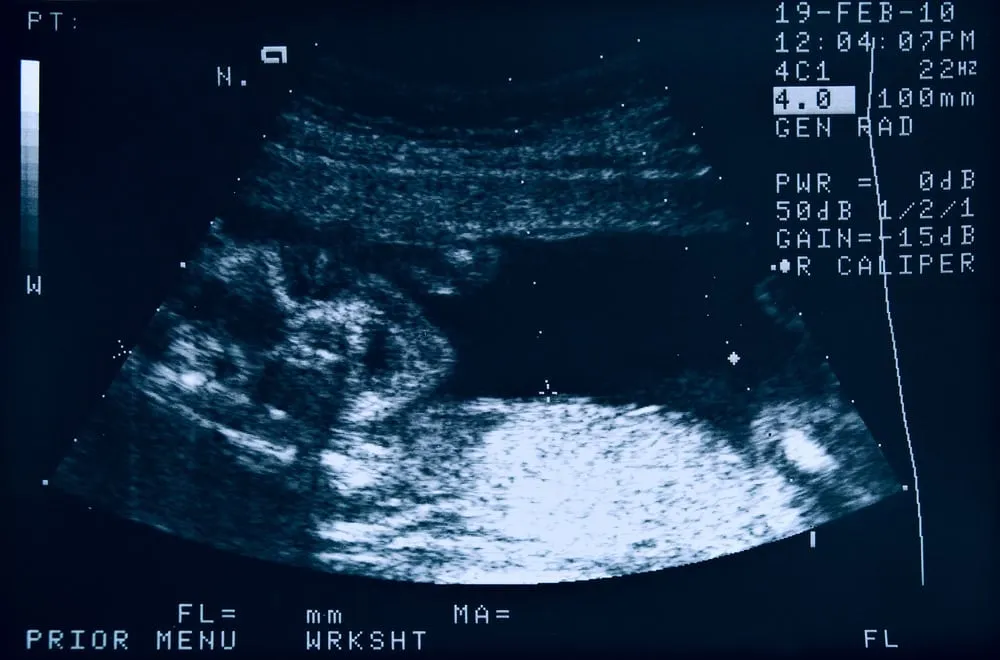 Hình ảnh siêu âm thai 22 tuần 