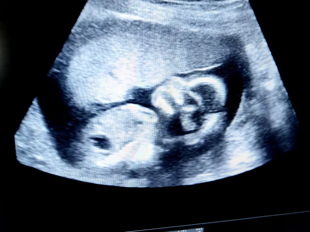 Hình ảnh thai 24 tuần trong bụng mẹ