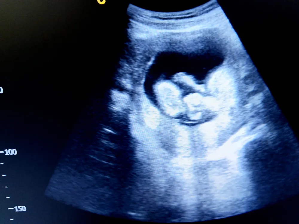 hình ảnh siêu âm thai 13 tuần