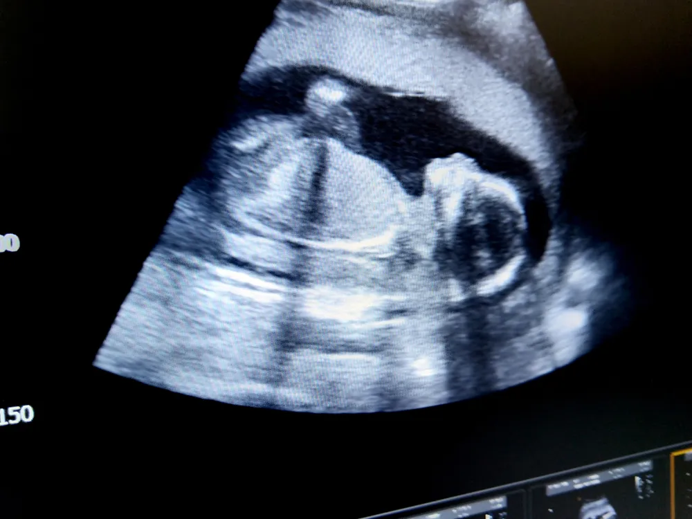 Fetus,18,Weeks,By,Ultrasound