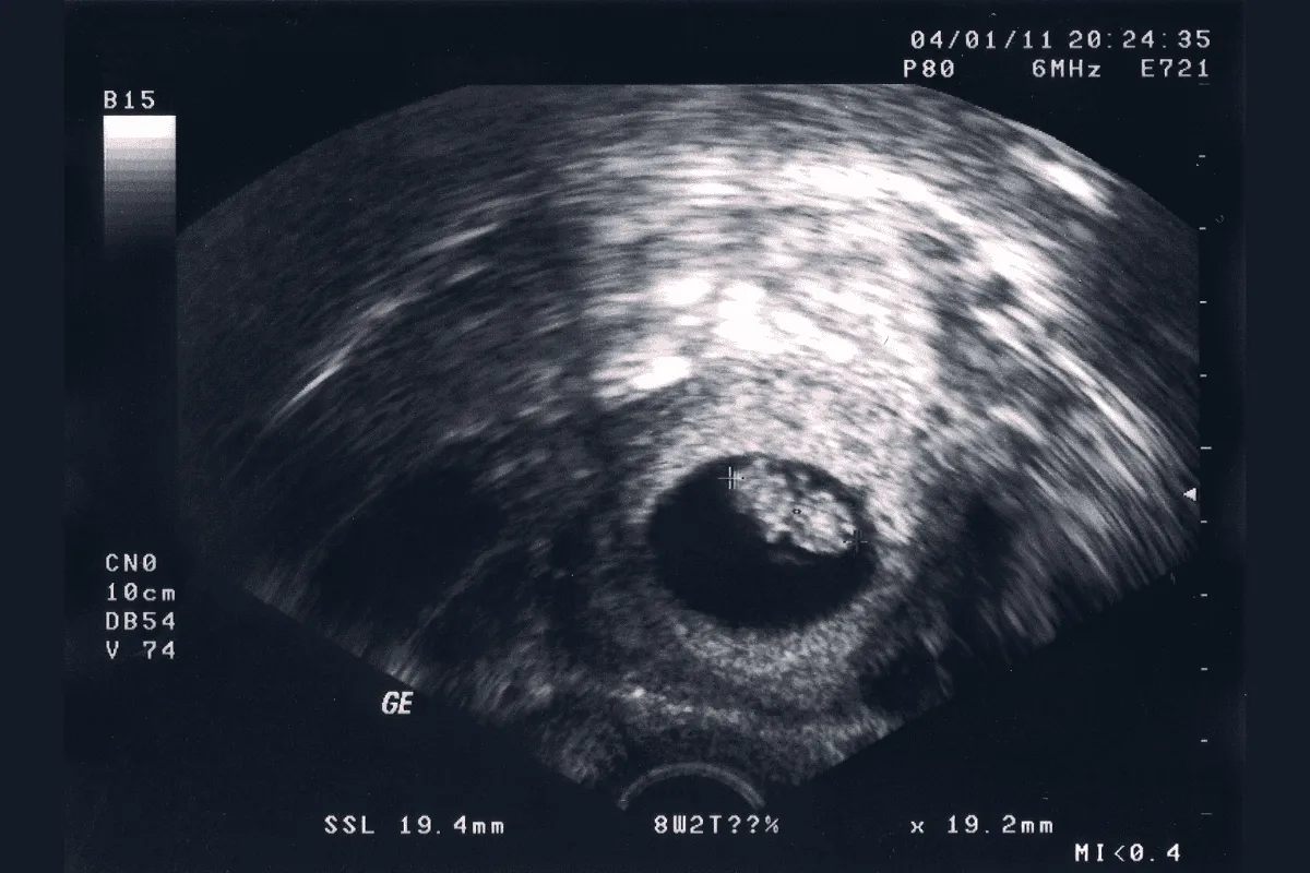 Siêu âm thai nhi 8 tuần