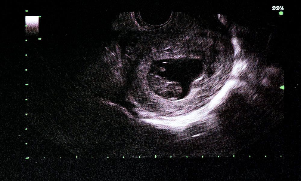 Thai nhi 9 tuần và những thắc mắc thường gặp