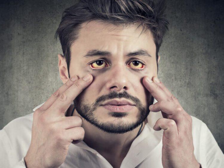 Dấu hiệu ung thư gan: vàng mắt