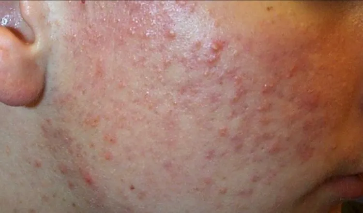 Triệu chứng bệnh da liễu là gì?