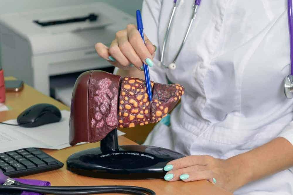 các giai đoạn ung thư gan được phân loại như thế nào?