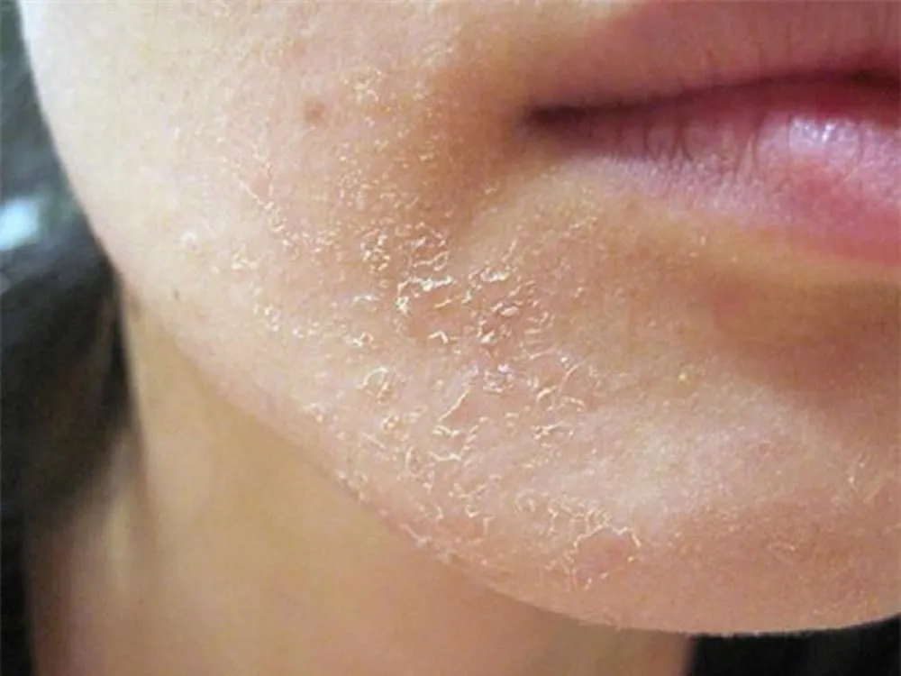 tác dụng phụ của axit salicylic