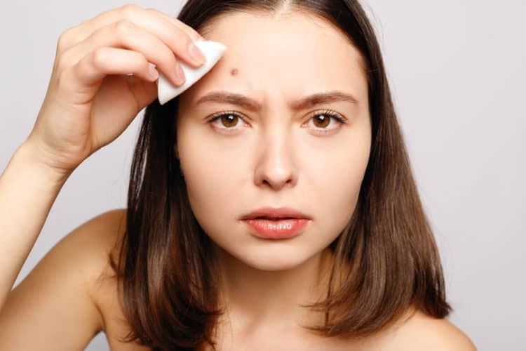 Mụn trứng cá dạng nang