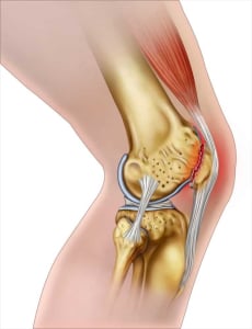 chấn thương đầu gối chấn thương khi chạy bộ