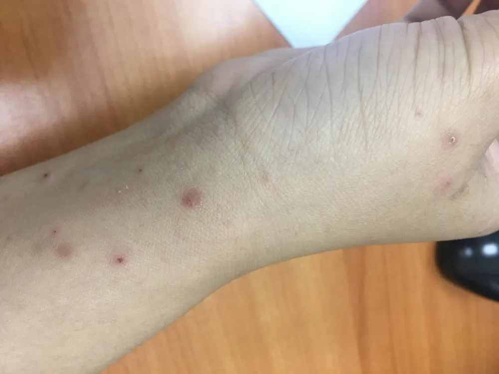 dấu hiệu bị ghẻ