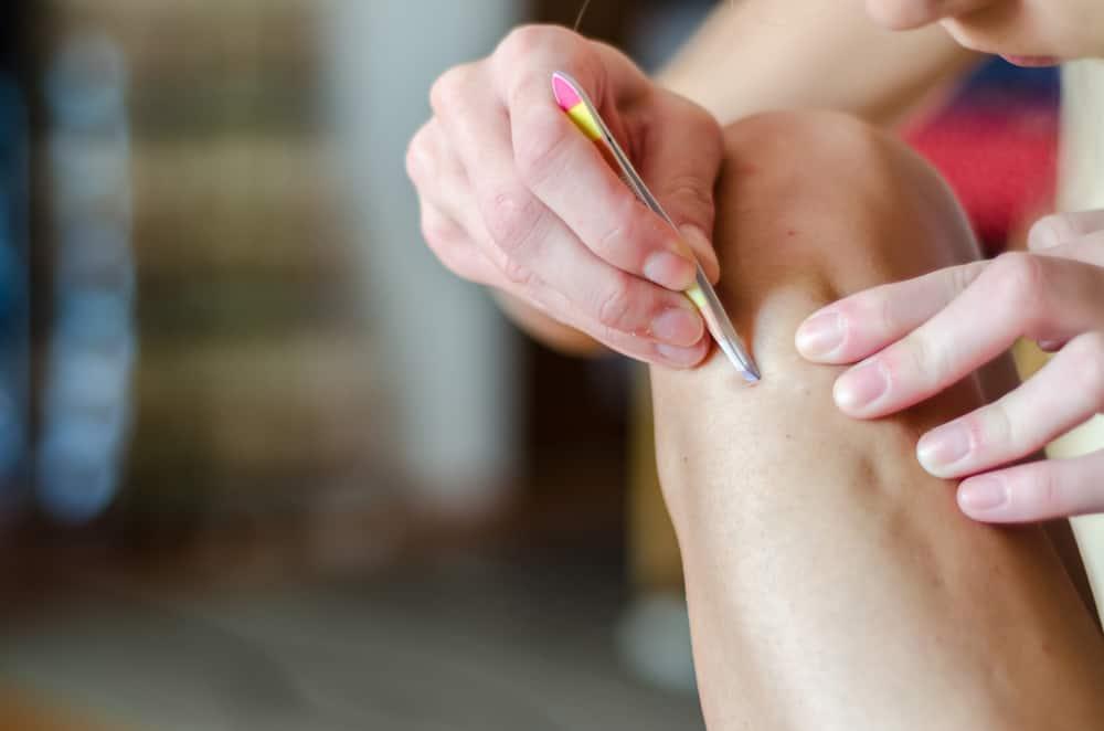 hiện tượng lông mọc ngược