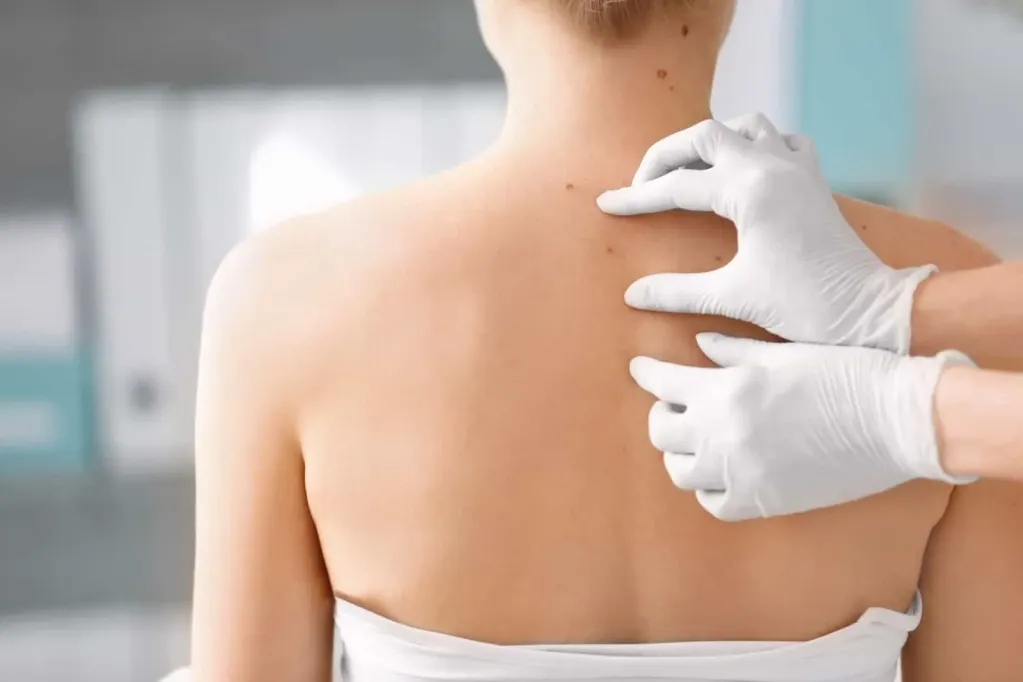 mụn thịt ở nách