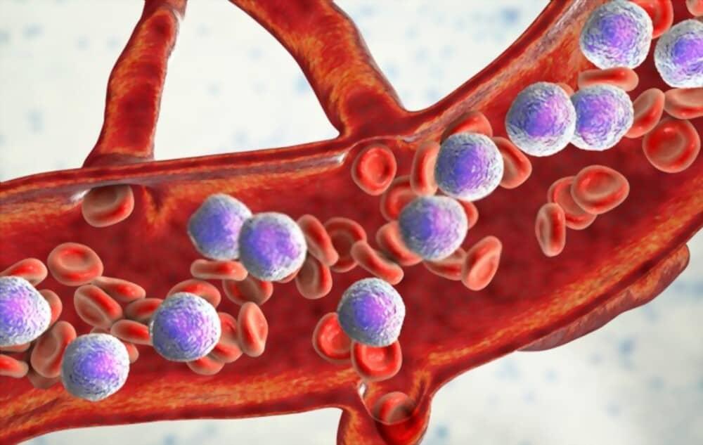 nguyên nhân bệnh bạch cầu