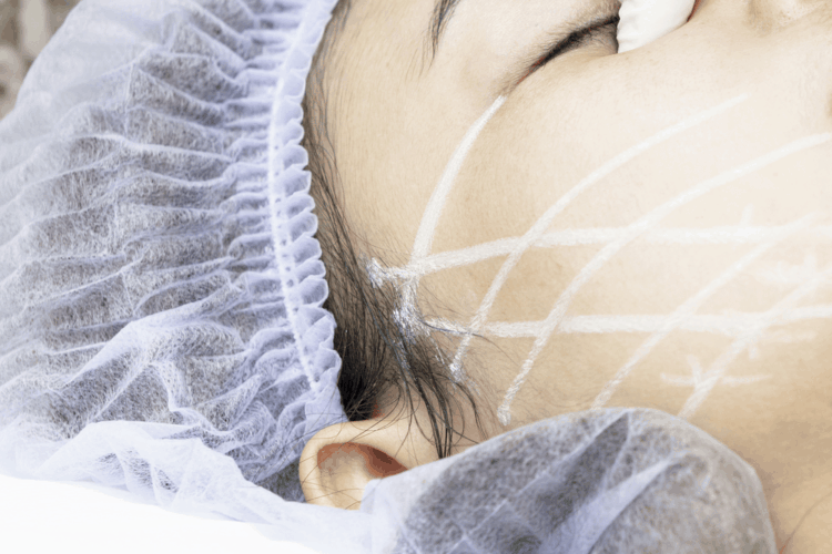 Căng da mặt bằng chỉ