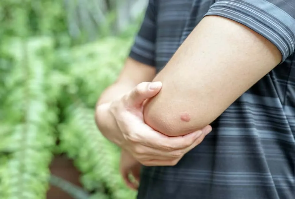 triệu chứng vết nhện cắn