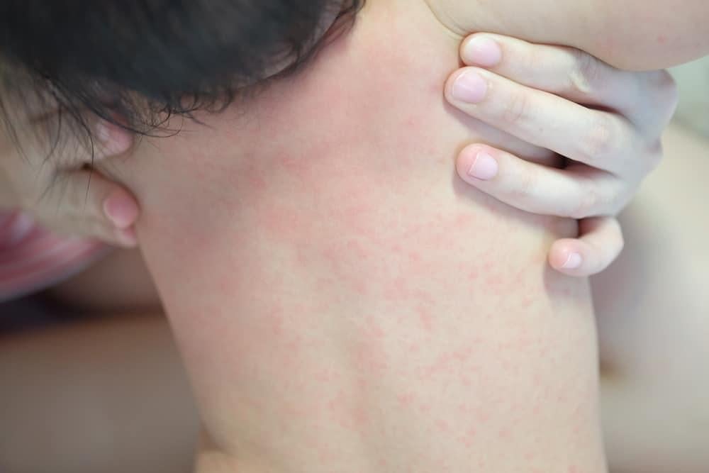 phát ban do tác dụng phụ của gentrisone