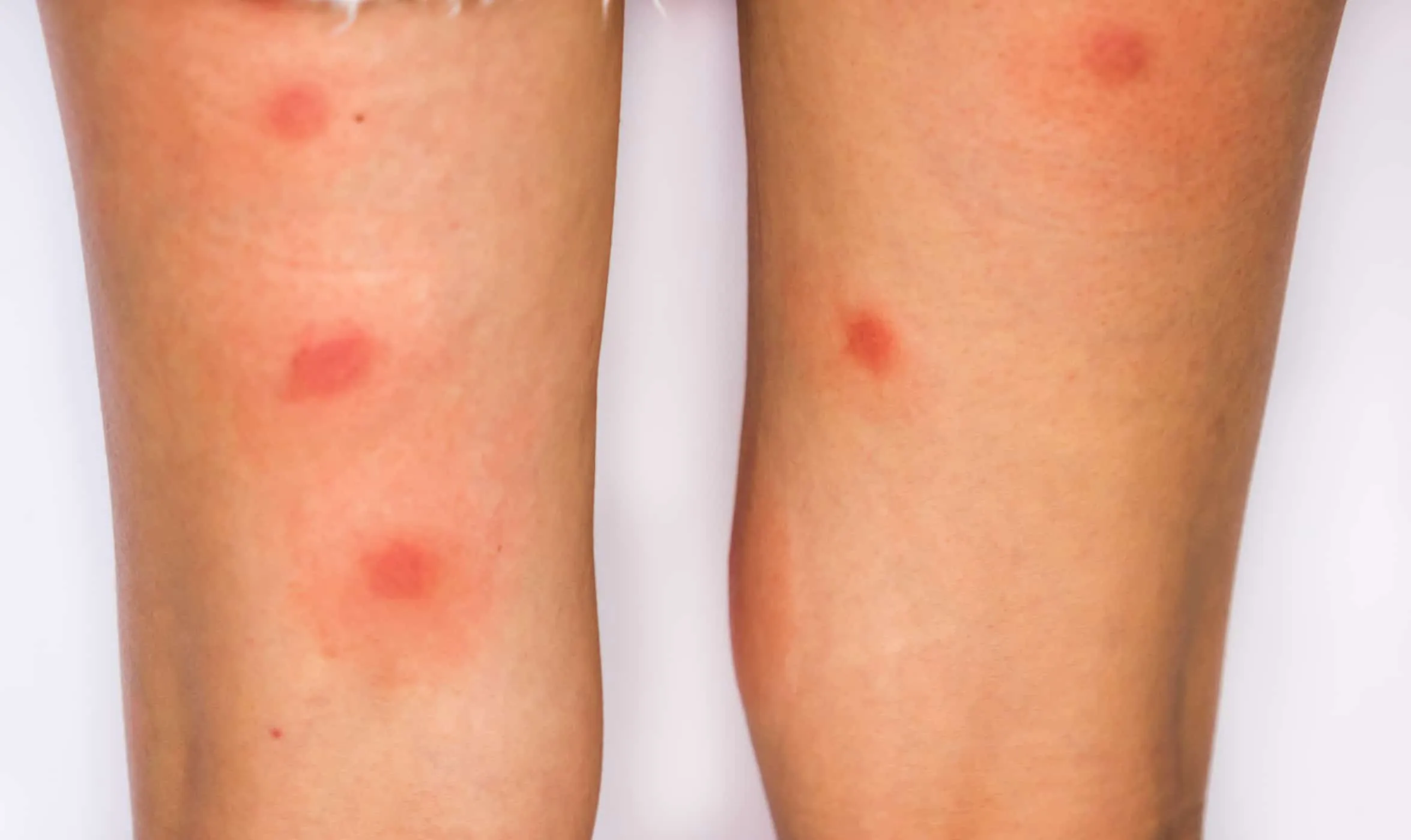 triệu chứng bọ ve cắn