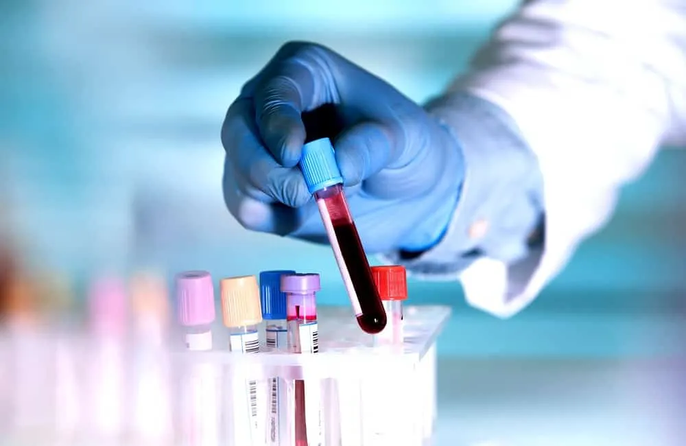 Xét nghiệm máu chẩn đoán bệnh giảm bạch cầu