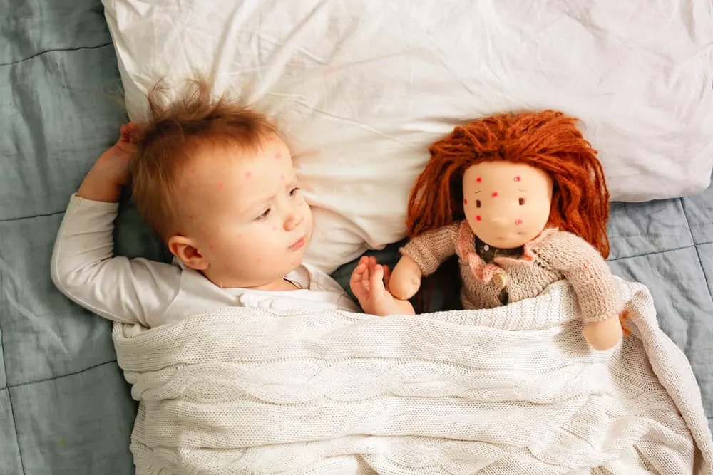 biến chứng thủy đậu