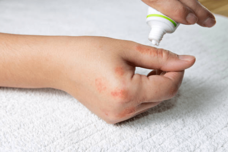 bôi thuốc trangala