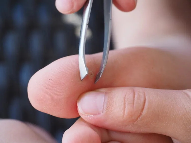 Kiểm tra vết dằm đâm vào da một cách kỹ càng