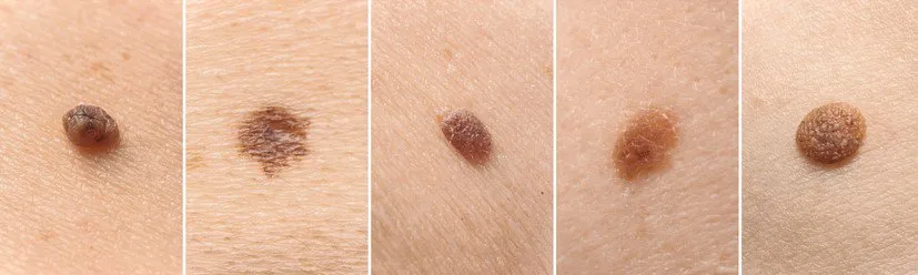 Các loại nốt ruồi bình thường và nốt ruồi báo ung thư