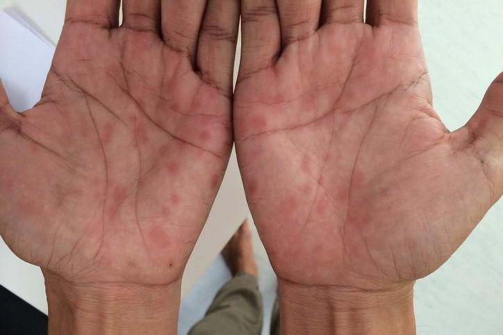 Lưu ý khi dùng thuốc Gentrisone