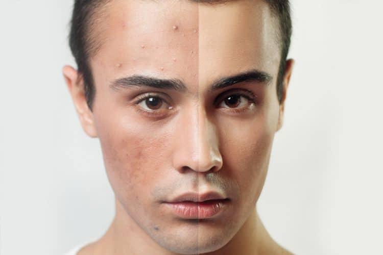 Mụn trứng cá ở nam giới