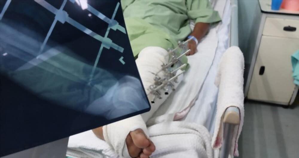 phẫu thuật gãy xương mác