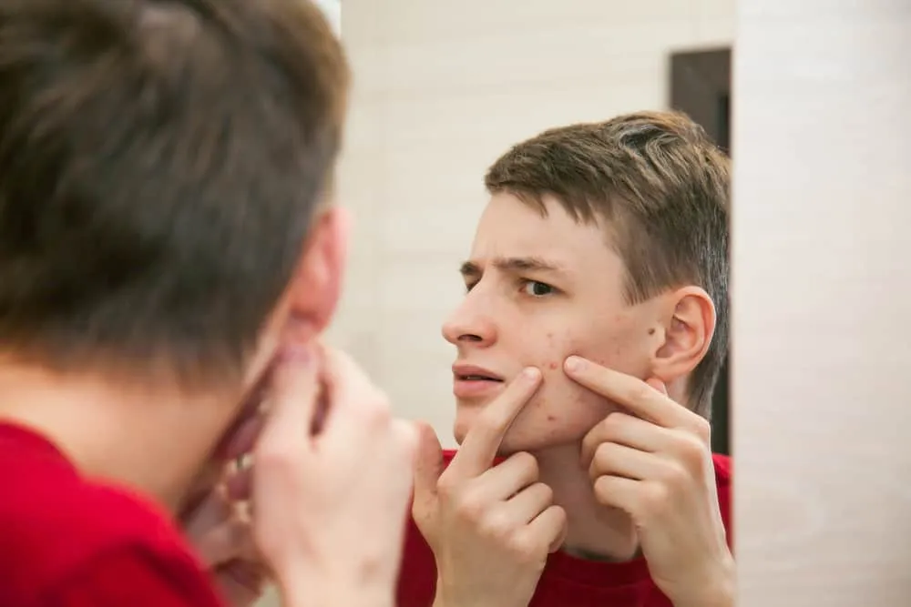 mụn do rối loạn nội tiết tố