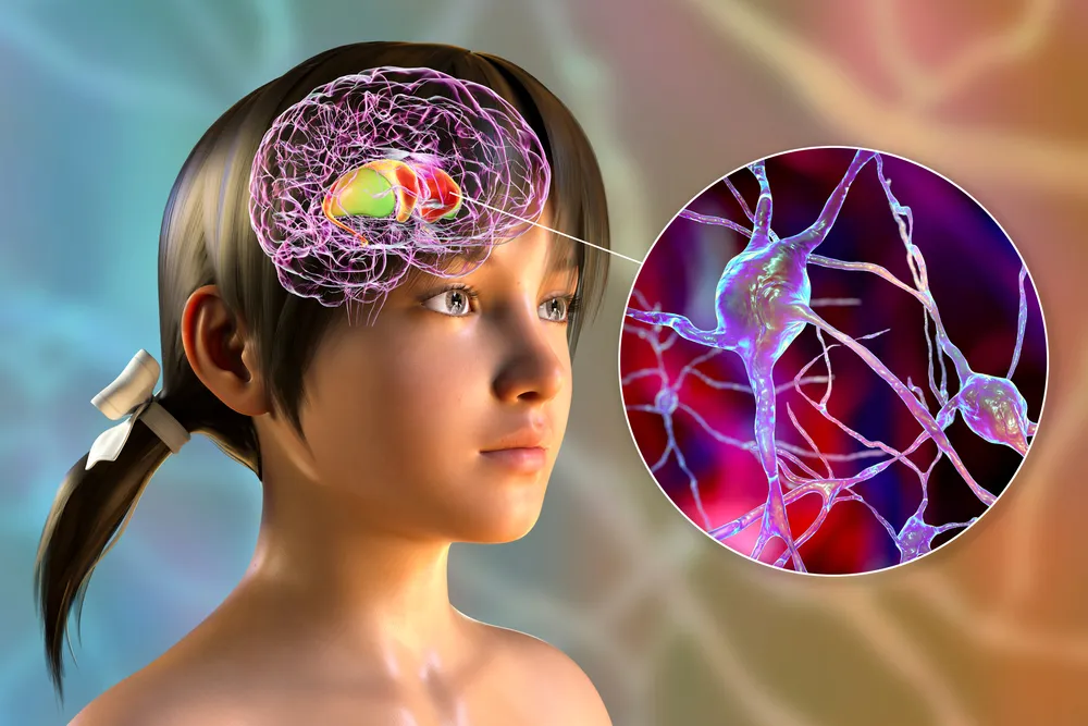 phẫu thuật kích thích não sâu