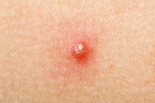 Nguyên nhân bị mụn nhọt là gì?