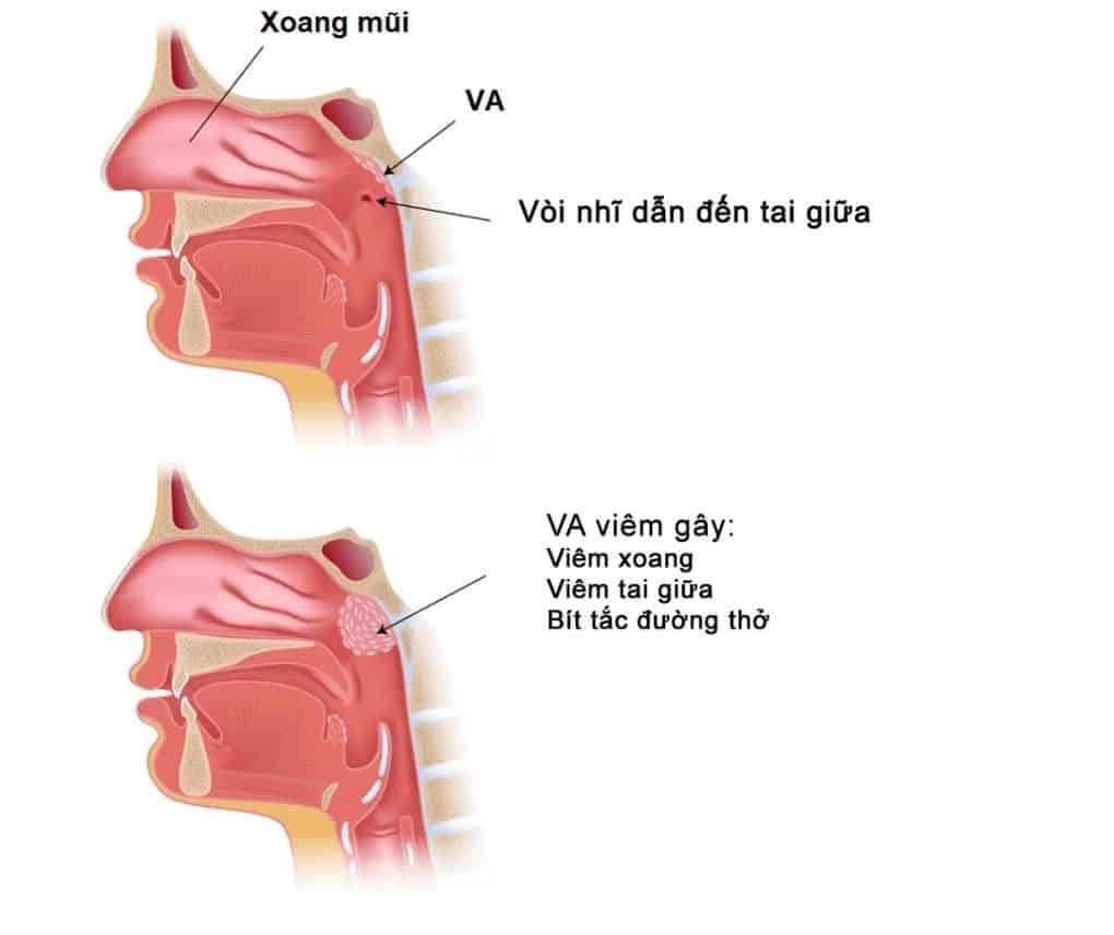 triệu chứng viêm VA